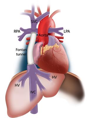 The Influence of Respiration on Blood Flow in the Fontan Circulation: Insights for Imaging-Based Clinical Evaluation of the Total Cavopulmonary Connection